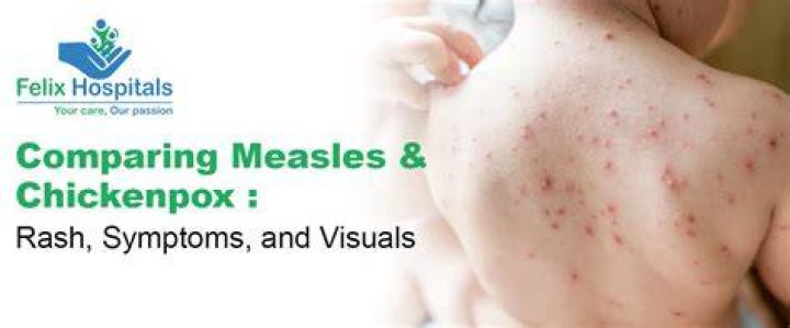 Can smallpox come back?